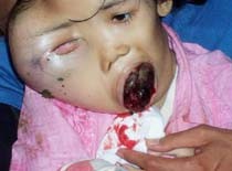 Kisah Bocah Riska yang Malang 