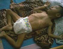 Rasyid, Balita Malang yang Perlu Uluran Tangan