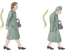 Kalsium dan Vitamin D Belum Cukup Atasi Osteoporosis