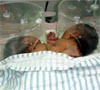 Bayi Siam Endang dan Indah Kritis