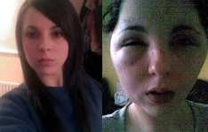 Wajah Lois Membengkak Mengerikan Setelah Pakai Cat Rambut