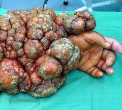 2 Manusia Kutil Dirawat di RSU Soetomo Surabaya 