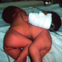 Tali Pusat Infeksi, Bayi Diberi Obat Triple Day