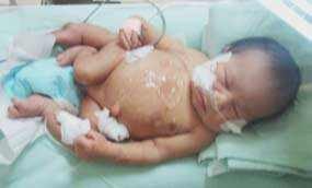 Tim Dokter RSCM Telah Buat Lubang Anus pada Bayi Berkaki 4