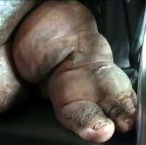 Penderita Kaki Gajah Gagal Dioperasi di RSU Soetomo