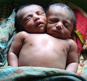 Kiron, Bayi Berkepala Dua