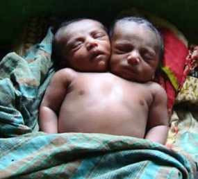 Bayi Berkepala 2 Meninggal Setelah Dibawa Pulang ke Rumah