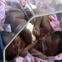 Ayah Bayi Kembar Siam Asal Nganjuk Masih Shock