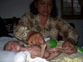 Usai Operasi Usus Terburai, Tubuh Arya Makin Kurus