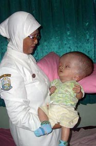 Bayi Hydrocepallus Tergolek Lemah Setahun di RS Madiun