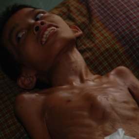 Rafi Lumpuh Total Akibat Gizi Buruk