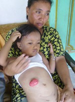 Sumbangan Bagi Windi Bocah Tanpa Anus Diperpanjang