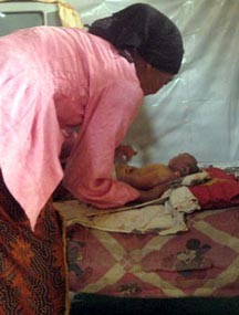 Bayi Tanpa Tempurung Kepala Akhirnya Meninggal