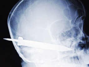 Dengan Pisau Menancap di Kepala, Pria Kunjungi RS