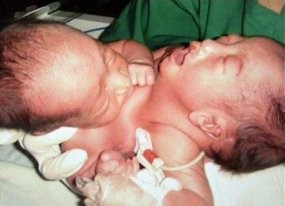 Bayi Kembar Siam Medan Miliki Kelainan Jantung