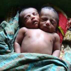 Dokter Teliti Kemungkinan Pemisahan Bayi Berkepala Dua
