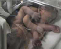 Bayi Kembar Siam Dempet Badan di Samarinda