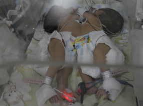 Bayi Kembar Siam Samarinda Dirujuk ke Surabaya