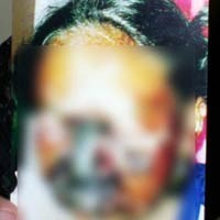 Nita Korban Malpraktek Dirujuk ke RSSA Malang