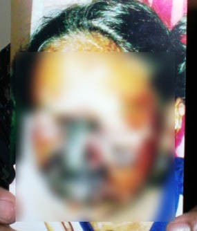 Nita Korban Malpraktek Dirujuk ke RSSA Malang