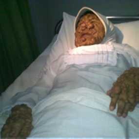 Yani Mulai Mendapatkan Tindakan Medis