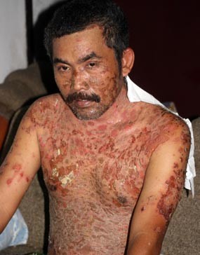 Warga Banyuwangi Terserang Penyakit Misterius