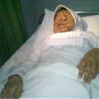 RSHS Siapkan 15 Labu Darah untuk Operasi Yani