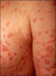 Pengobatan Sejak Dini Kurangi Penyakit Psoriasis Hingga 75 Persen