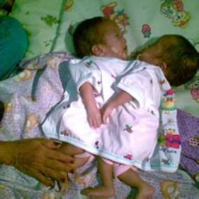 Fadlan dan Fadli Kembar Siam Satu Jantung dan Satu Hati