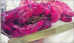 Ranting Cemara Tumbuh di Paru-paru Manusia?