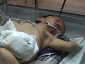 Bayi Kembar Berkepala di Perut Dipindahkan Ke Ruang ICU