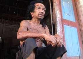 15 Tahun Mulyono Idap Penyakit Kulit Misterius