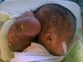 Bocah Usia 16 hari Terserang Hydrocephalus