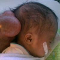 Bocah Usia 16 hari Terserang Hydrocephalus