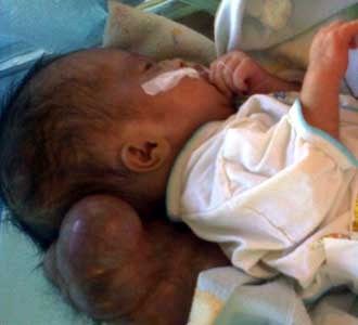 Suryani Terserang Hydrocephalus
