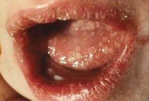 Herpes Zoster