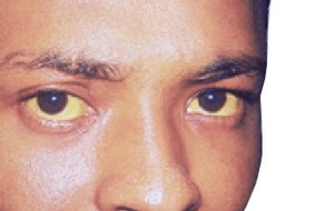 Hepatitis A