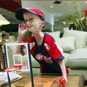 Derita Anak Progeria, Tua Sebelum Waktunya