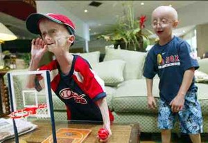 Derita Anak Progeria, Tua Sebelum Waktunya