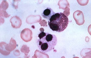 Thalasemia
