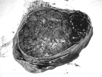 Solusio Plasentae