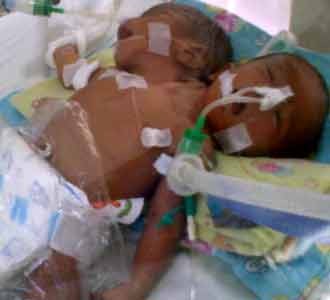 Bayi Berkepala Dua di Riau