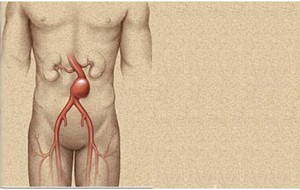 Aneurisma Aorta Abdominalis 