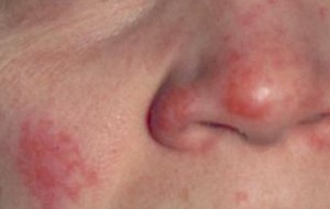 Lupus
