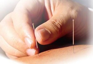 Akupuntur Kurangi Kelebihan Hormon Testosteron Perempuan 