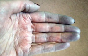 Raynaud