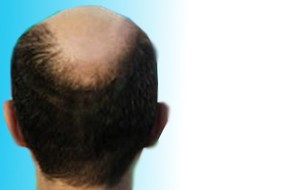 Rambut Rontok