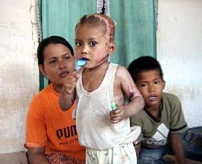 Dirawat 58 Hari, Fery Bisa Bermain Lagi