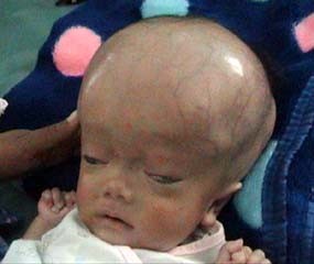Bocah 4 Bulan Terserang Hydrocepalus