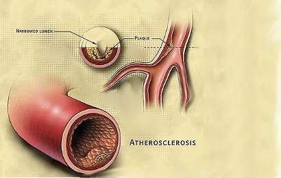 Image result for plak pada dinding arteri